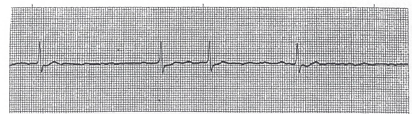 Atrial fibrillation with rapid ventricular response