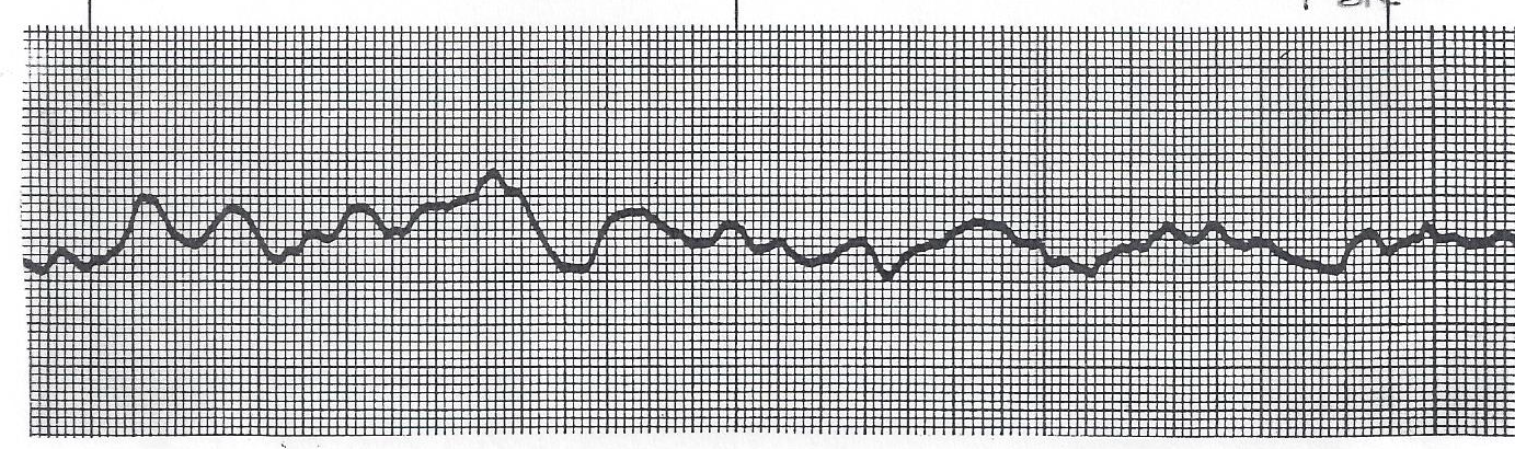 Coarse ventricular fibrillation