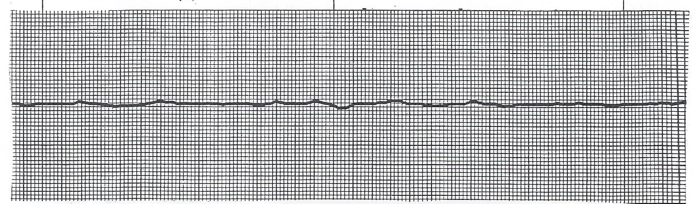Fine VFib / near-asystole