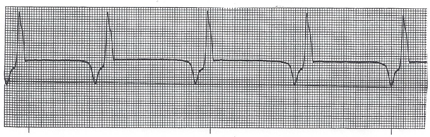 Idioventricular rhythm