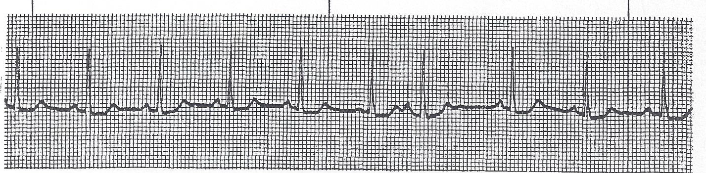 NSR with premature atrial complex (PAC)