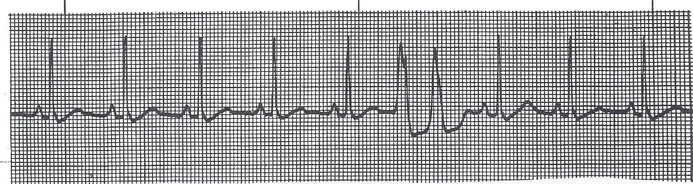 NSR with PVC couplet