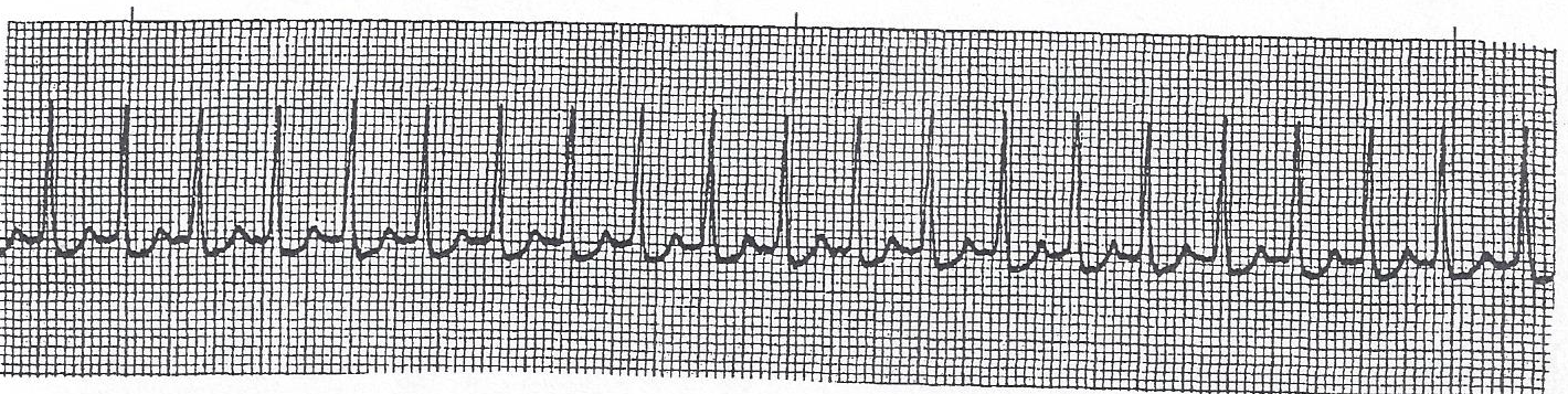 Supraventricular tachycardia (SVT)